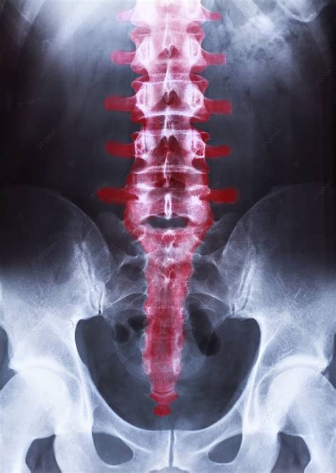 Fondo Radiografía De La Pelvis Y La Columna Vertebral Anatomía Cuerpo