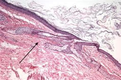 Histology Showing Cyst Hair Follicle Sebaceous And Sweat Glands