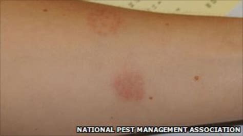 The Bedbug Summit Banishing The Itchy Insects Bbc News