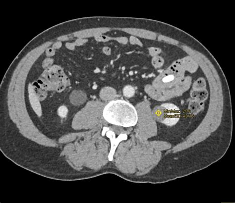 Parapelvic Cysts Left Kidney Kidney Case Studies Ctisus Ct Scanning