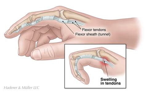 Patient Education Article Colorado Springs Orthopaedic Group Pe