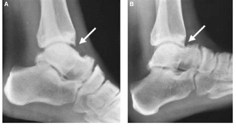 Figure 1 From Arthroscopic Treatment Of Anterior Ankle Impingement