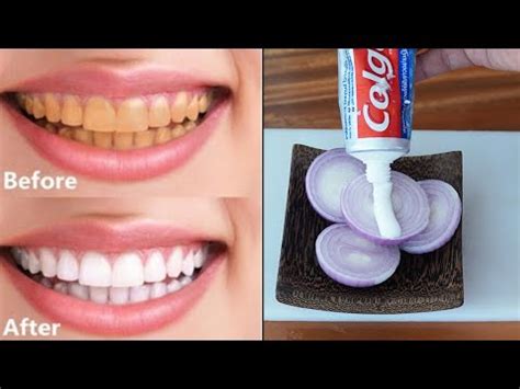 Armandhammer.com has been visited by 10k+ users in the past month How To Remove Yellow Teeth In 3 Minutes | Magical Teeth ...
