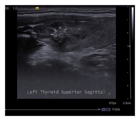 Thyroid Ultrasound Disclosed A Hypoechoic Nodule Of 155 × 135 × 12 Mm