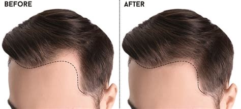A Fresh Look Unveiling The Benefits Of Hair Transplant Your Art Pages