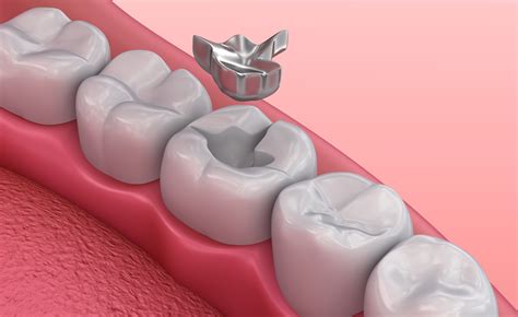 What Are Silver Fillingsdental Amalgam Made Of