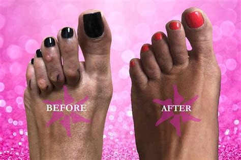 Fix Your Feet Foot Surgery Results Gallery