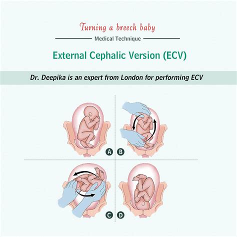 Breech Baby And External Cephalic Version Dr Deepika Aggarwal A