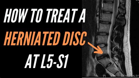 How To Cure L5 S1 Disc Herniation Tutor Suhu