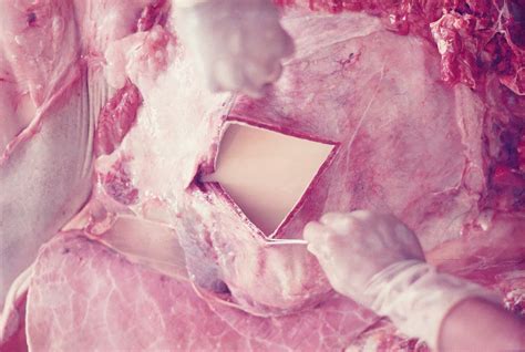 La pericardite è un'infiammazione del pericardio la membrana che riveste il cuore. Patologia Veterinária: Pericardite supurada em bovinos