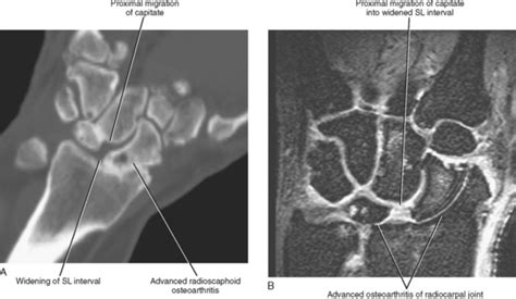 Imaging Of The Wrist Radiology Key