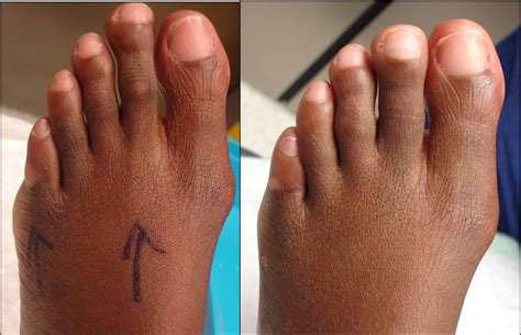 Toe Shortening Surgery Pictures