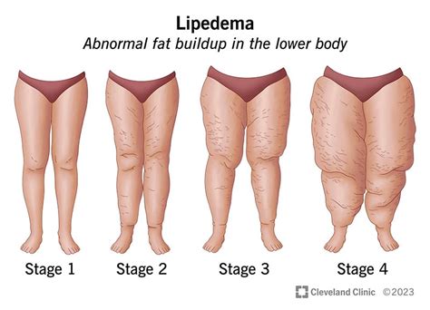 Lipedema Causes Symptoms And Treatment