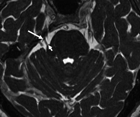 Radiology Anatomy Images Trigeminal Nerve Mri Anatomy Sexiz Pix