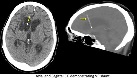Axial And Sagittal Ct Demonstrating Ventriculoperitoneal Vp Shunt
