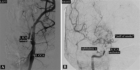 Conventional Cerebral Angiogram Of Our Patient A The Lica Is Occluded