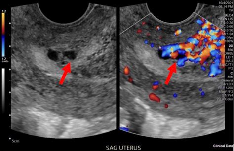 A Rare Case Of Multiple Uterine Artery Pseudoaneurysms After