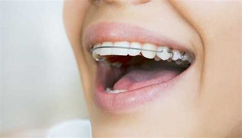 Have A Permanent Orthodontic Retainer Cleaning Tips Sabka Dentist Top Dental Clinic Chain