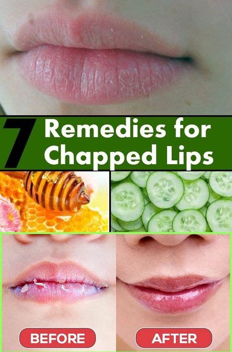 Chapped Lips Home Remedy Chapped Lips Chapped Lips Remedy Fast Dry