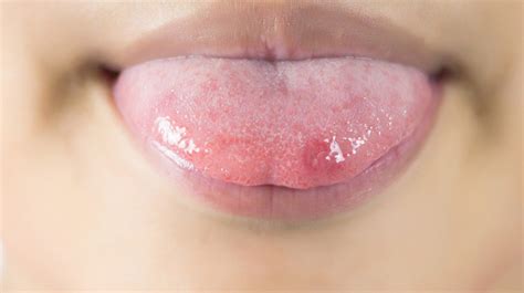 What To Do About Swollen Tongue Bumps