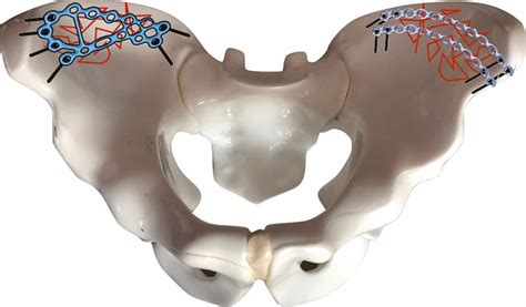 Schematic drawing showing bilateral comminuted fracture of ...