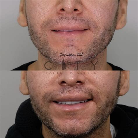 Nyc Male Lip Lift Ues Male Lip Enhancement Augmentation Surgery