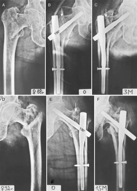 Complications Of Trochanteric Fractures Musculoskeletal Key