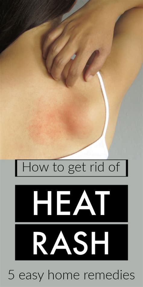 How To Get Rid Of Heat Rash 5 Easy Home Remedies Heat Rash Heat