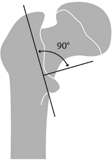 Graphic Representation Of The Osteotomy Planes For Creating The Lesser