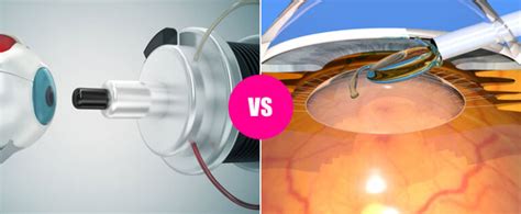 Laser Eye Surgery Vs Lens Replacement Surgery What Do You Need To Know