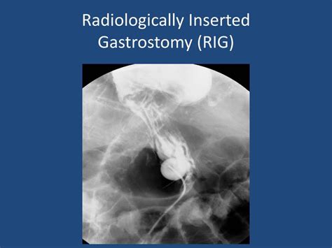 Ppt Interventional Radiology In The Older Patient Powerpoint