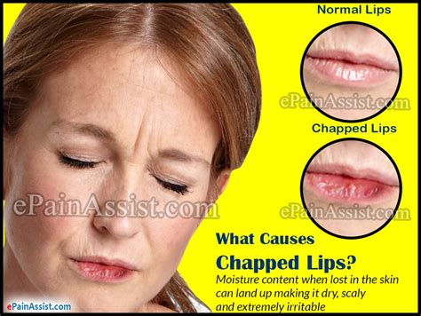 What Medical Condition Causes Chapped Lips