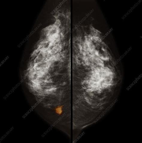 Breast Cancer Mammogram Stock Image C0349500 Science Photo Library