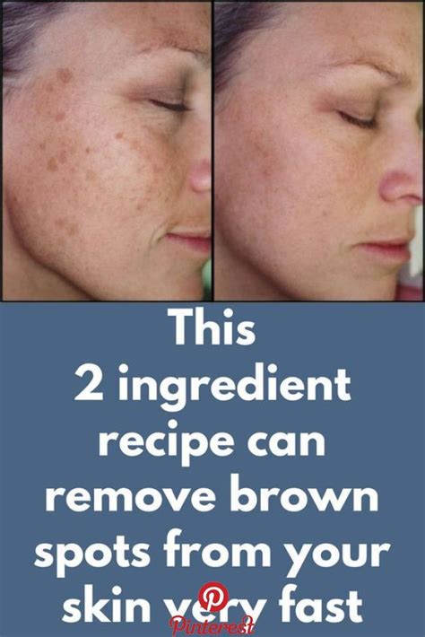 This 2 Ingredient Recipe Can Remove Brown Spots From Your Skin Very