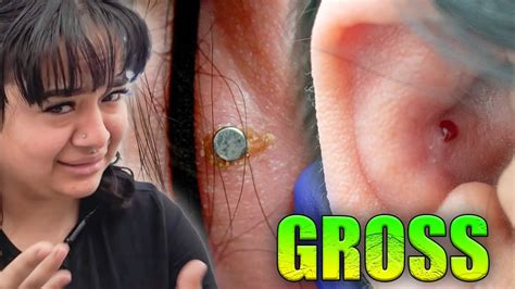 Removing Her Infected Conch Piercingremoval Youtube