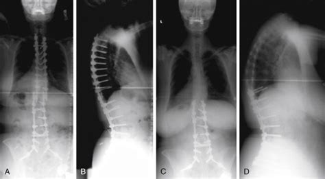 L1 S1 Fusion When To Extend To T12 And Pelvis And When To Include L5