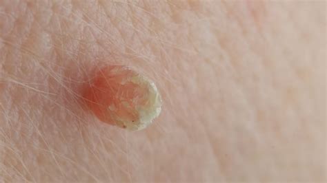 How Skin Tags Are Caused And How To Remove Them Reviewed