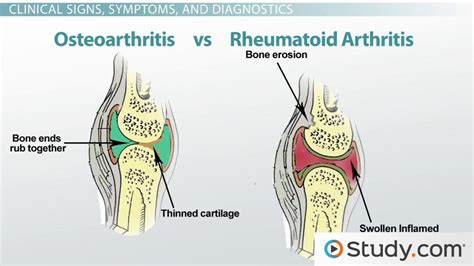 what is rheumatoid arthritis causes symptoms and treatment video and lesson transcript