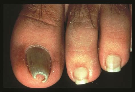 Under The Microscope Pincer Nails Nail Disorders Nails And Disorders