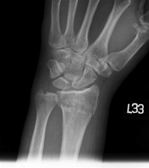 Displaced Colles Fracture