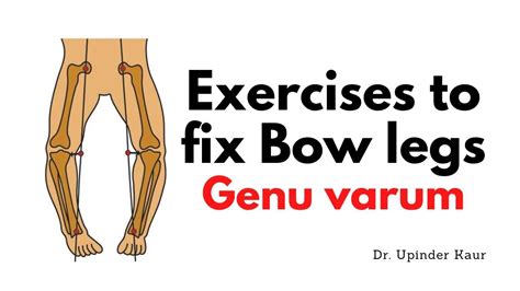 Exercises To Fix Bow Legs Genu Varum Youtube