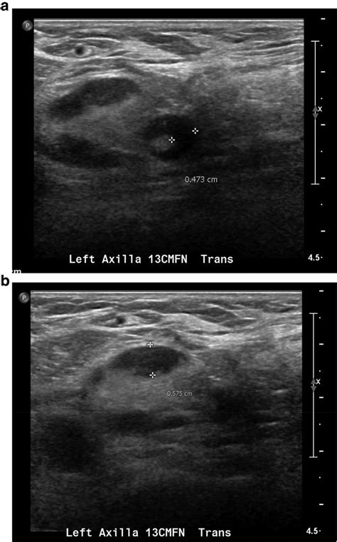 A B Targeted Left Axillary Ultrasound Performed 2