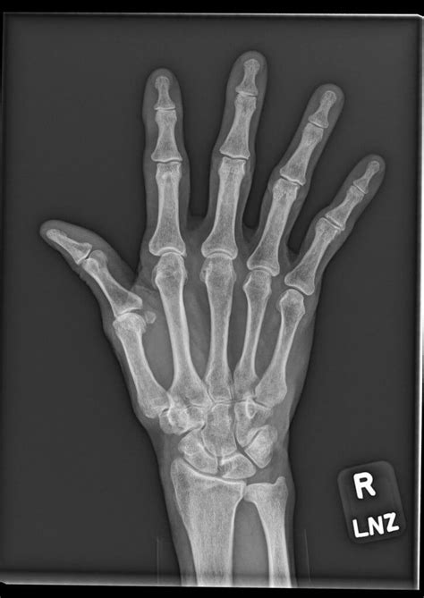 Orthodx Cyst On Index Finger Clinical Advisor