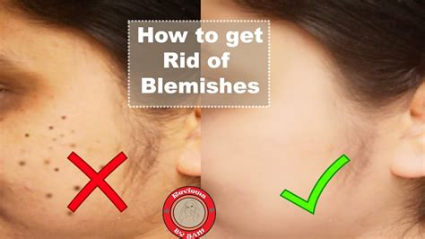 How To Get Rid Of Blemishes And Uneven Skin Tone Dermatologist