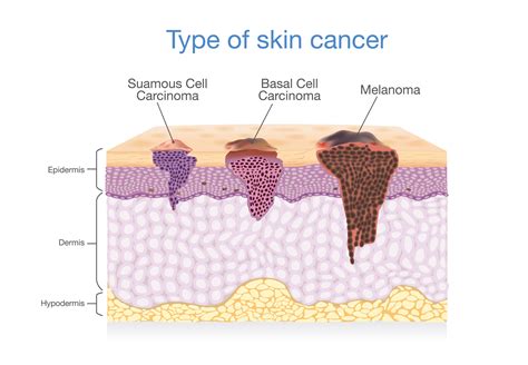 The Importance Of Annual Full Body Skin Exams Recognize And Treat