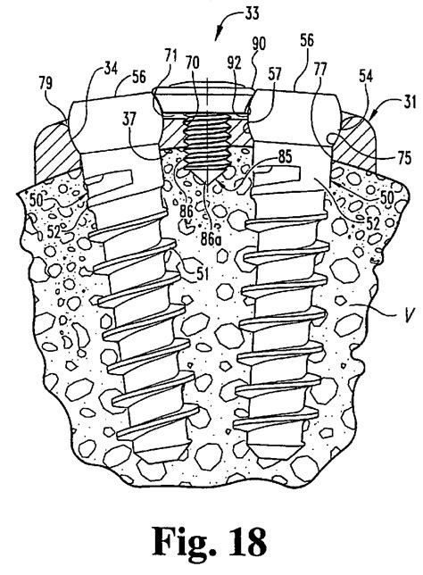 Skyline Anterior Cervical Plate System