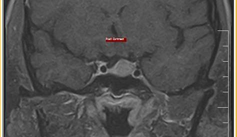 Rathke's Cleft Cyst :MRI - Sumer's Radiology Blog