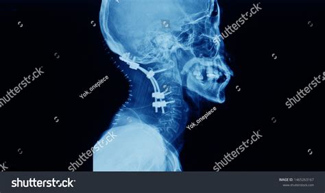 Lateral Projection Xray Cervical Spine Showing Stock Photo 1465263167