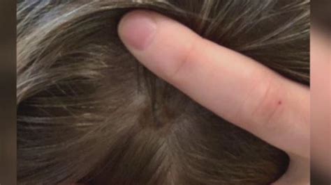 Womans Mole On Her Head Is Found To Be Melanoma How She Caught It