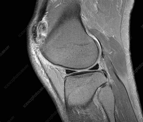 Normal Knee Mri Scan Stock Image C Science Photo Library